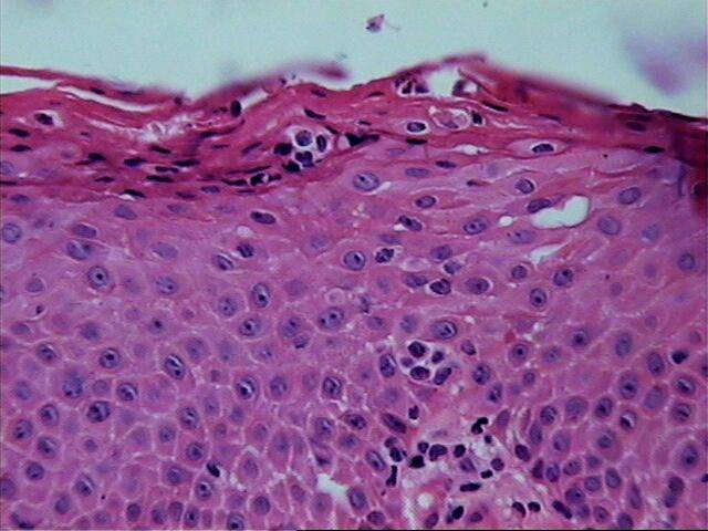 Fig.13 Microabsceso en estrato crneo - <div style=